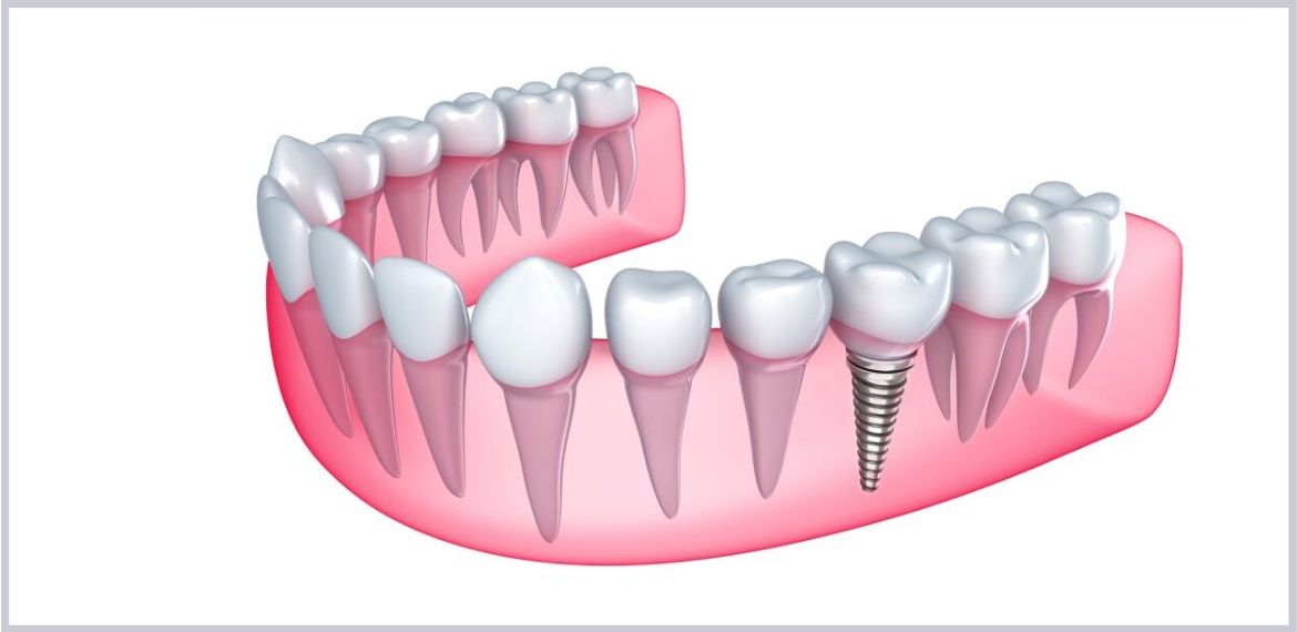 Banner - Customised Emulate Implants